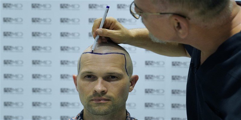 Natural Hair Transplant: Does Hair Transplant Look Natural?