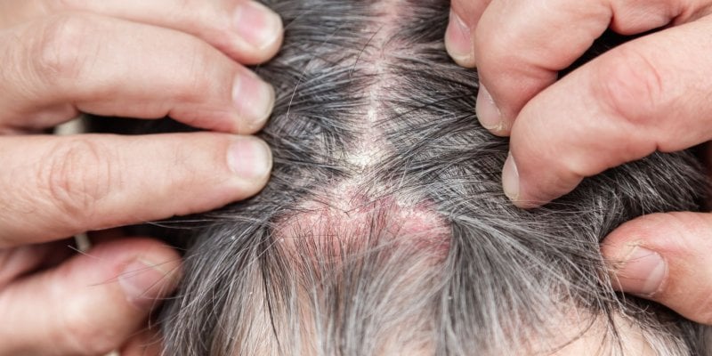 Itchy Scalp and Hair Loss