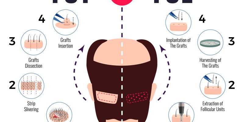 FUE Vs FUT Hair Transplant