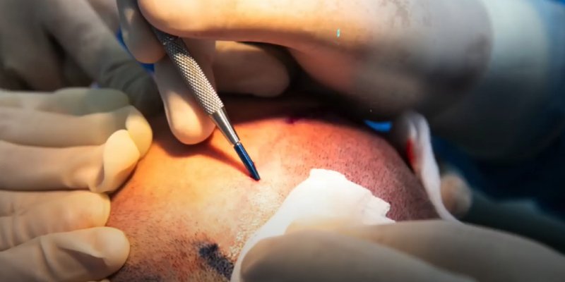 Hair Transplant From Another Person: Risks and Success Rate