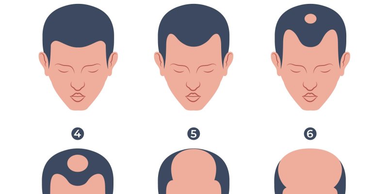Hair Loss Patterns