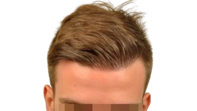 Asmed Hair Transplant | Fue Hair Transplant Turkey Asmed Hair Transplant | Fue Hair Transplant Turkey