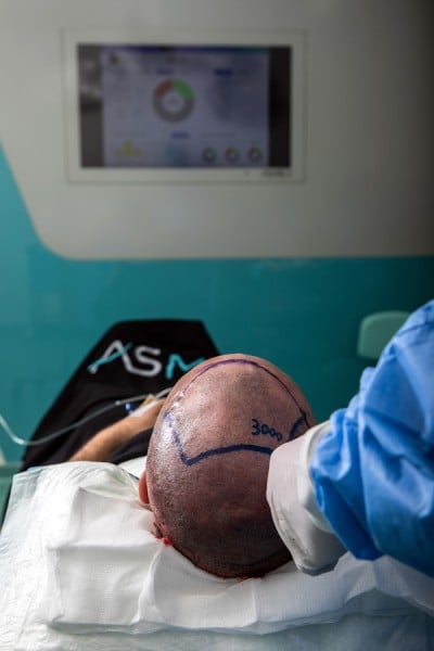hair transplant extraction