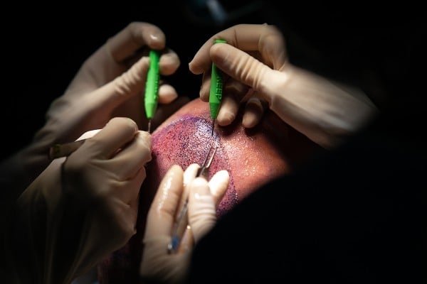 hair transplant recipient