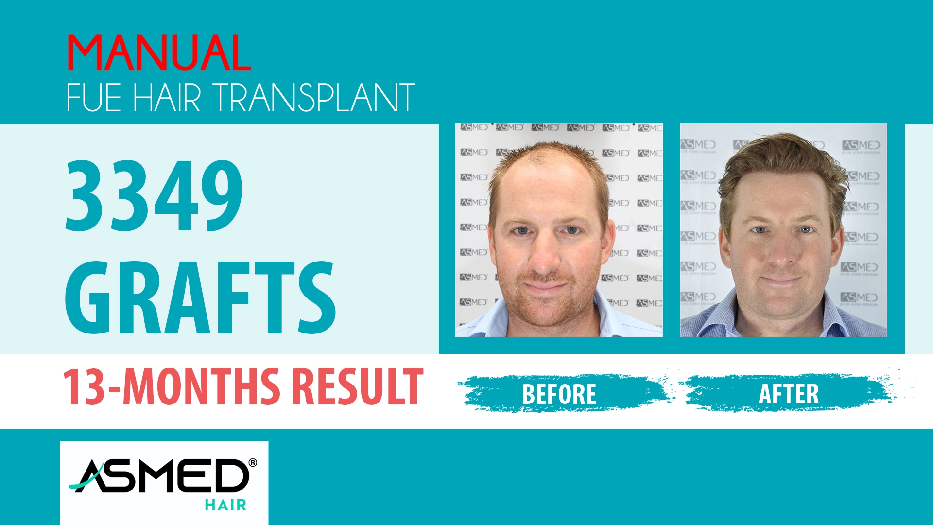 3349 grafts manual fue before after