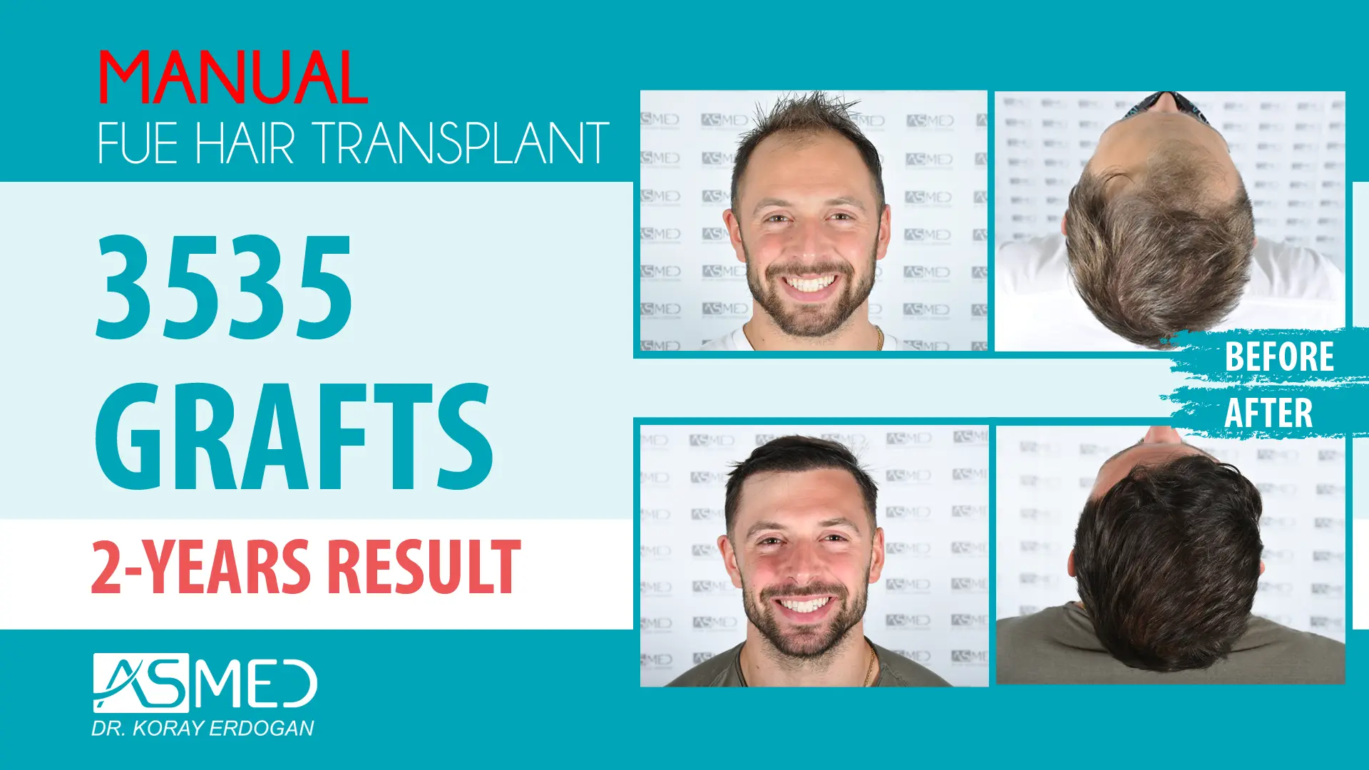 3535 grafts manual fue before after
