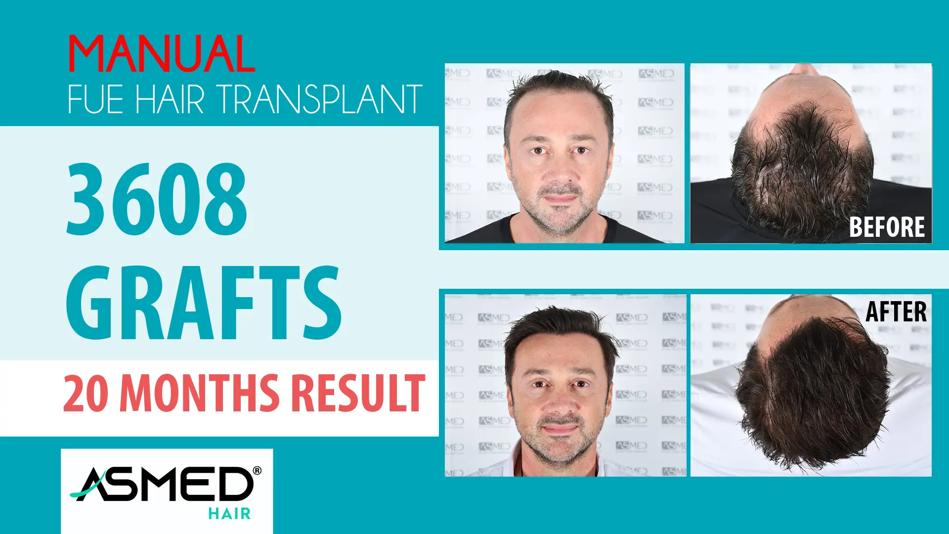3608 grafts manual fue before after