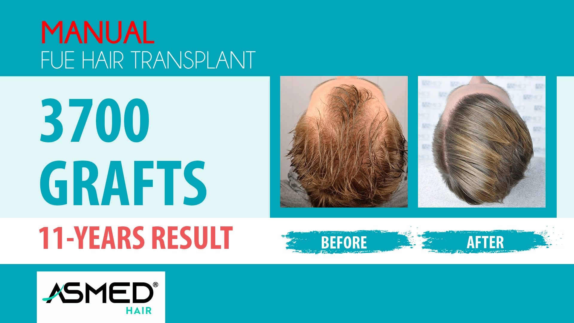 3700 grafts manual fue before after