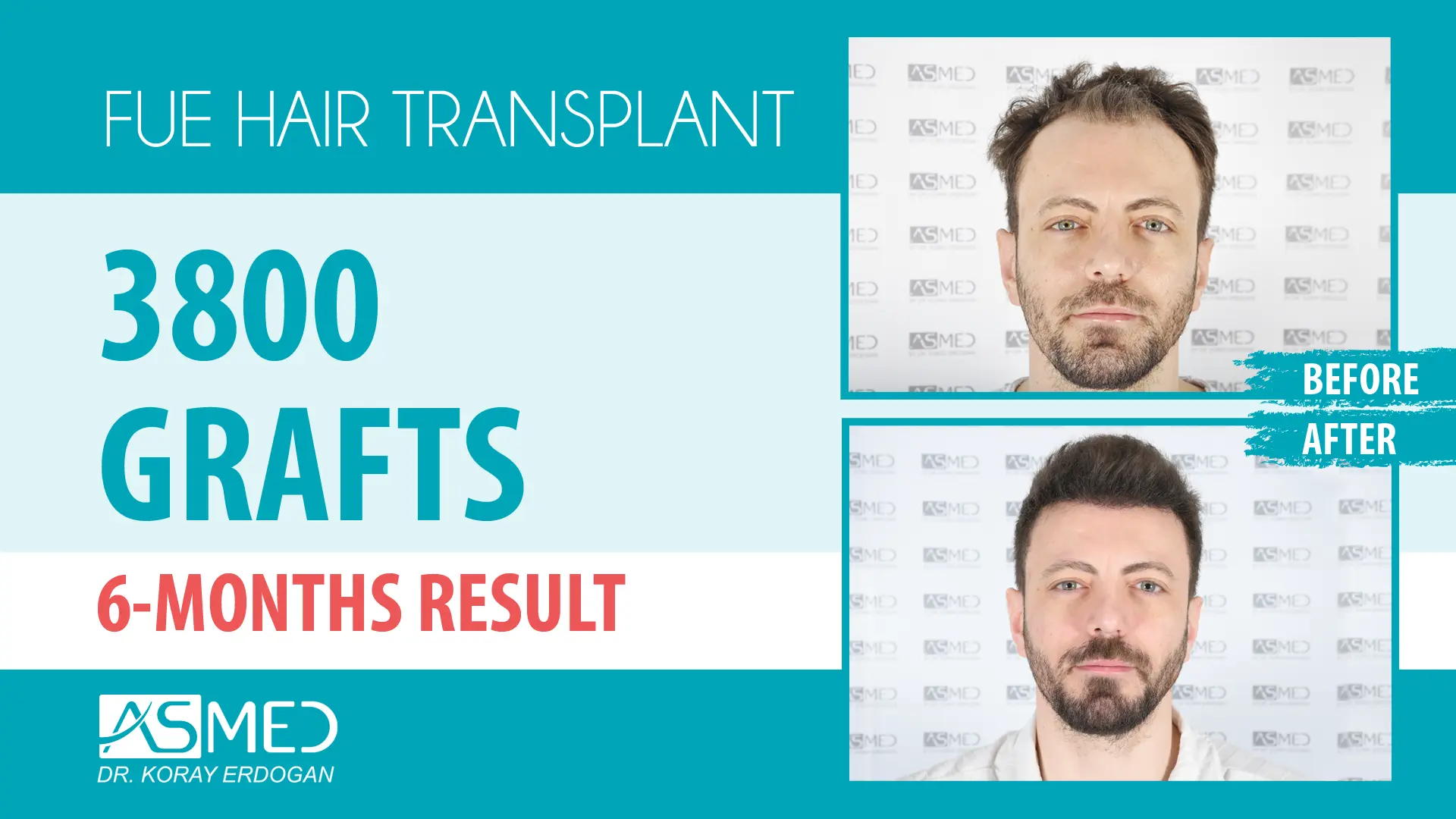 3800 grafts manual fue before after