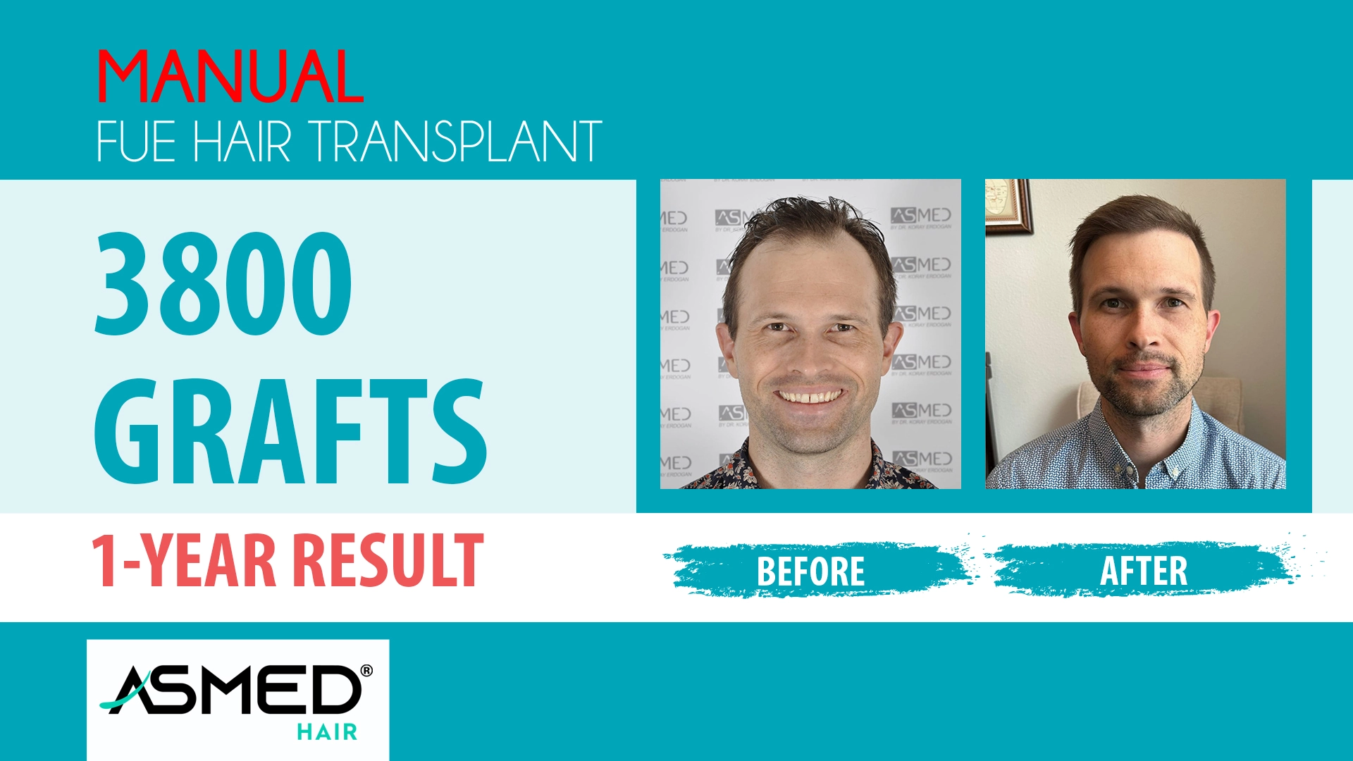 3801 grafts manual fue before after