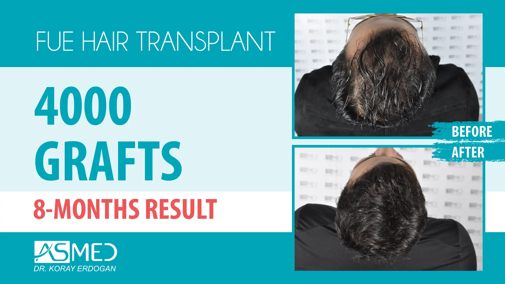 4000 grafts manual fue before after