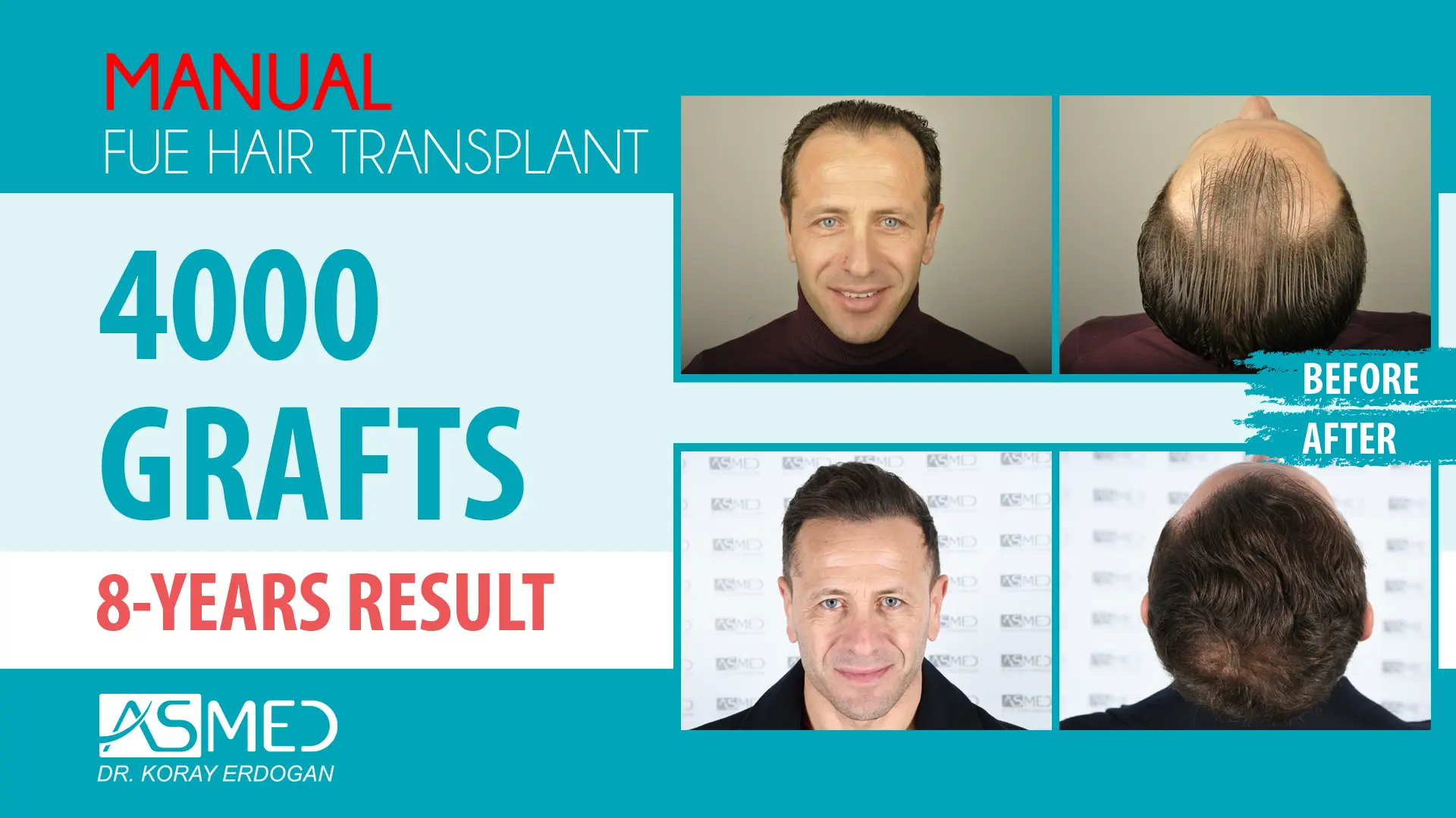 4001 grafts manual fue before after