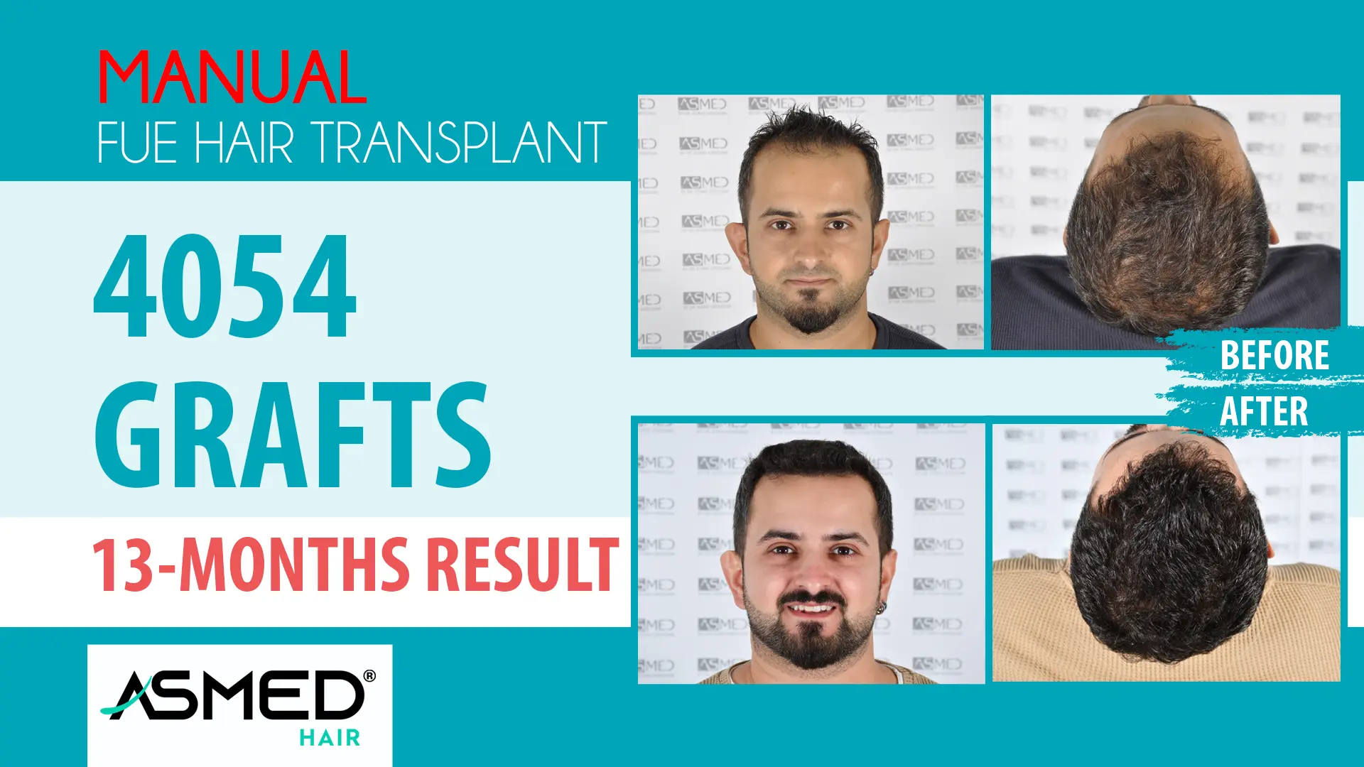 4054 grafts manual fue before after