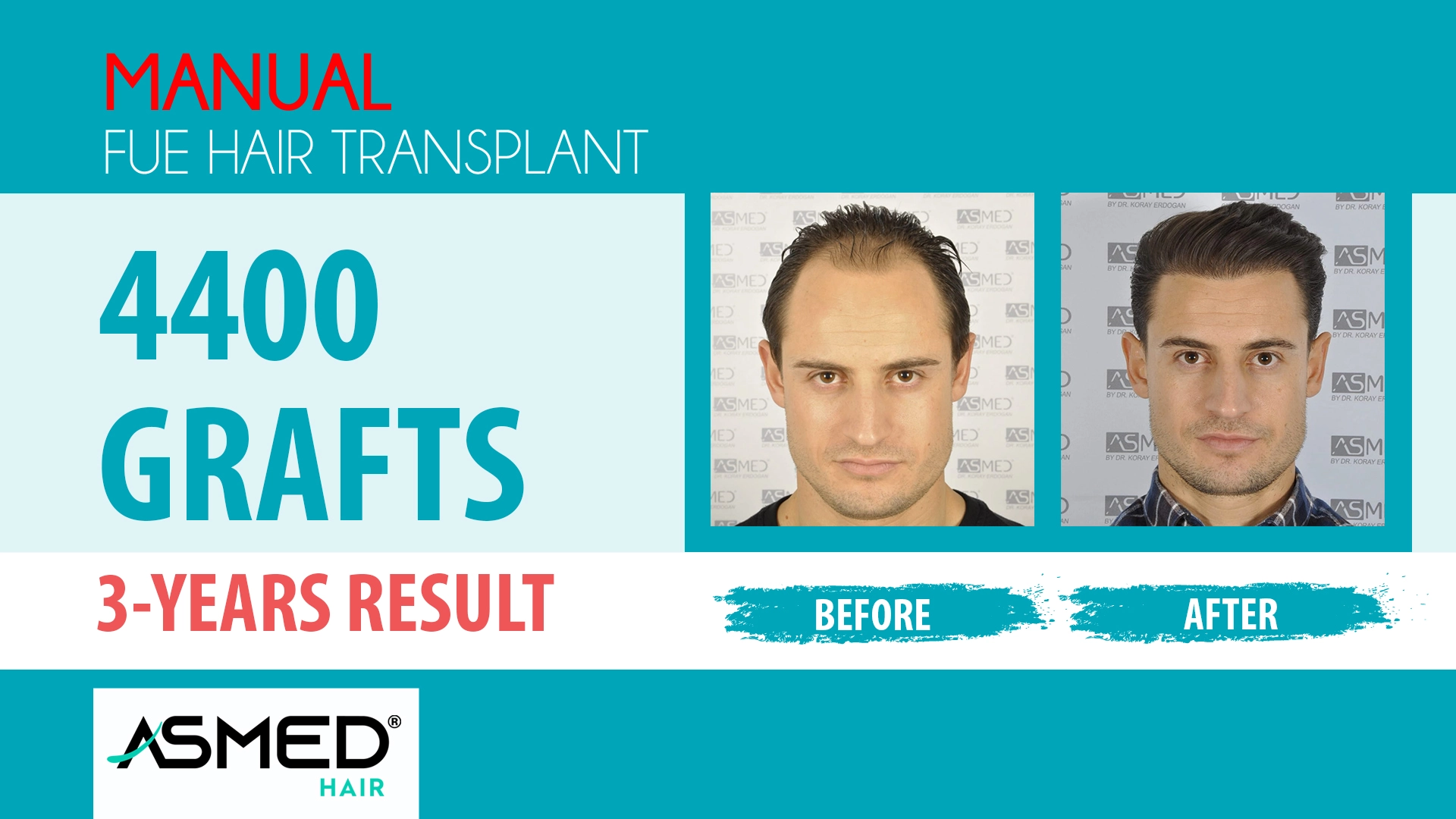 4400 grafts manual fue before after