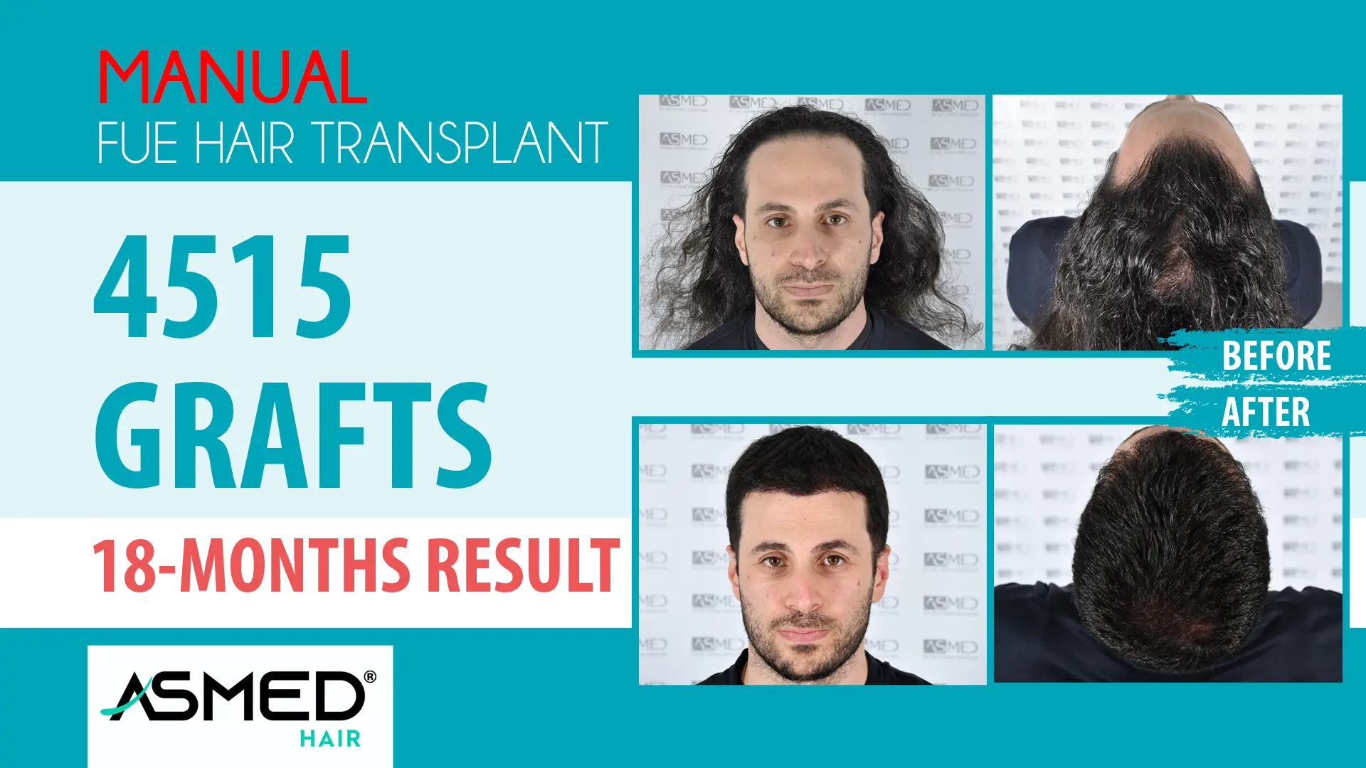 4515 grafts manual fue before after