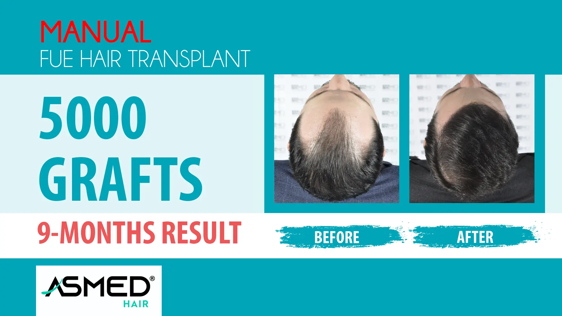 5002 grafts manual fue before after