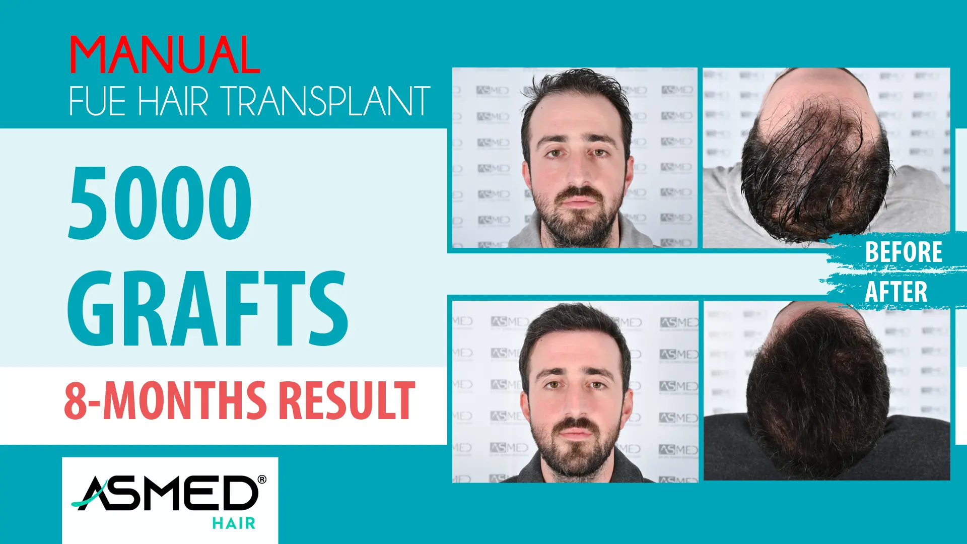 5005 grafts manual fue before after