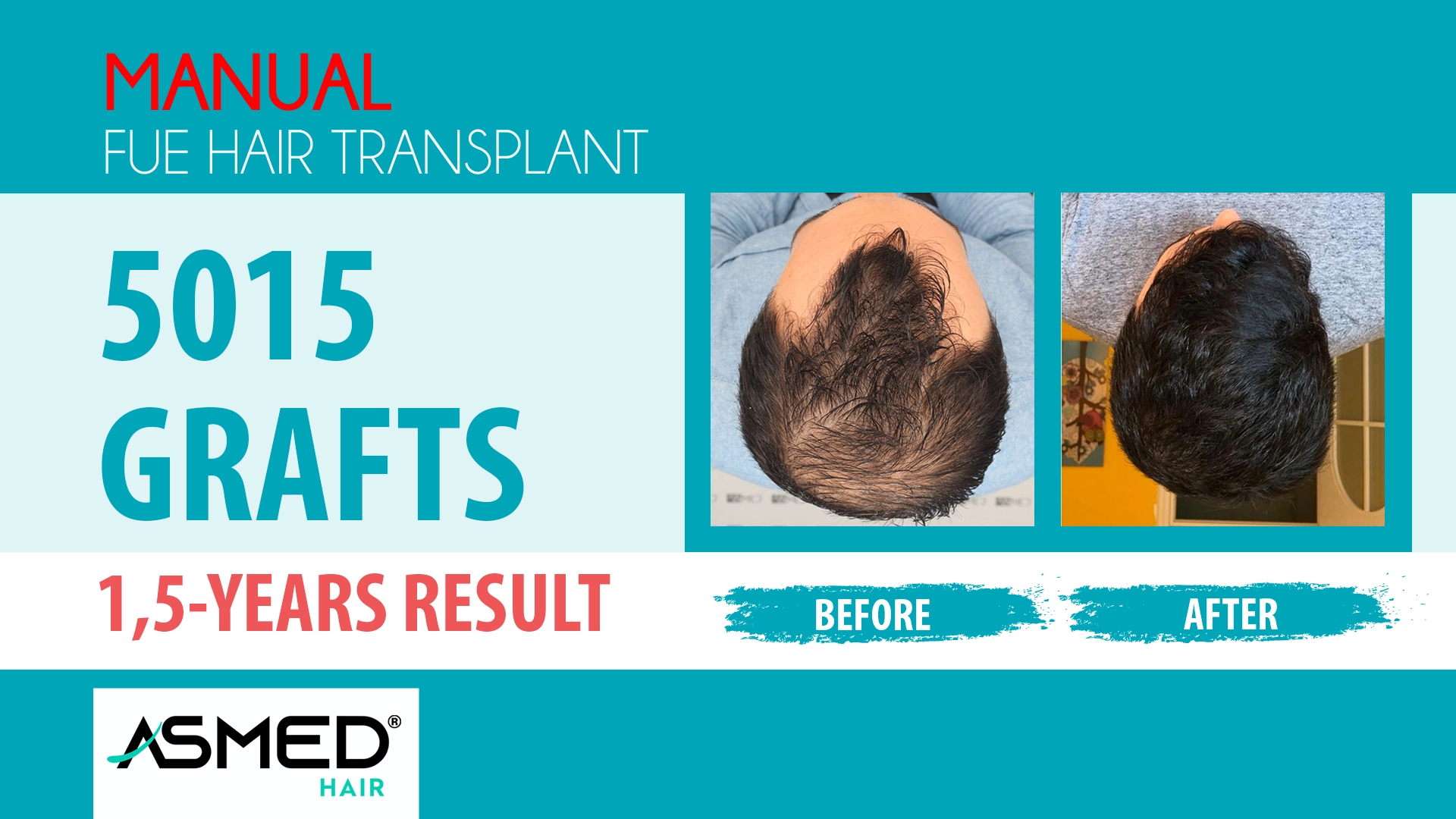 5015 grafts manual fue before after