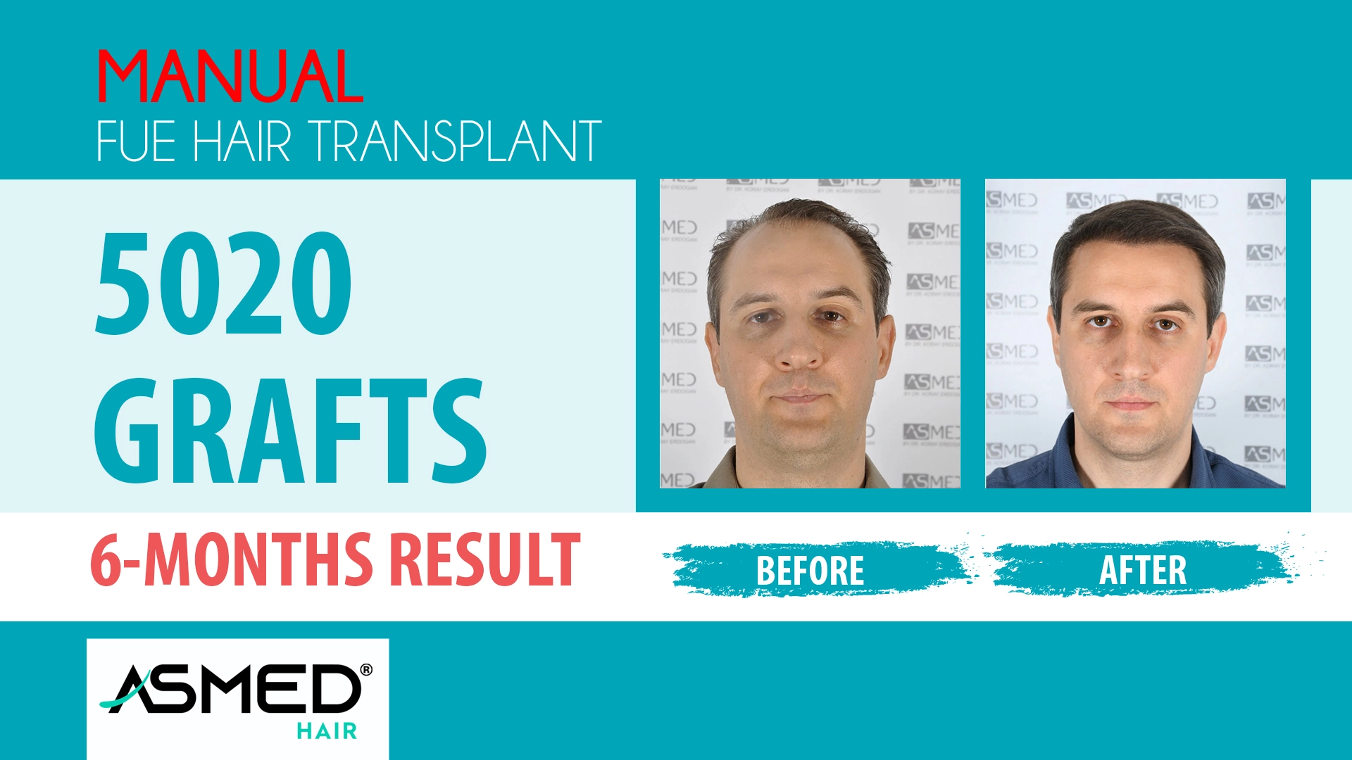 5020 grafts manual fue before after
