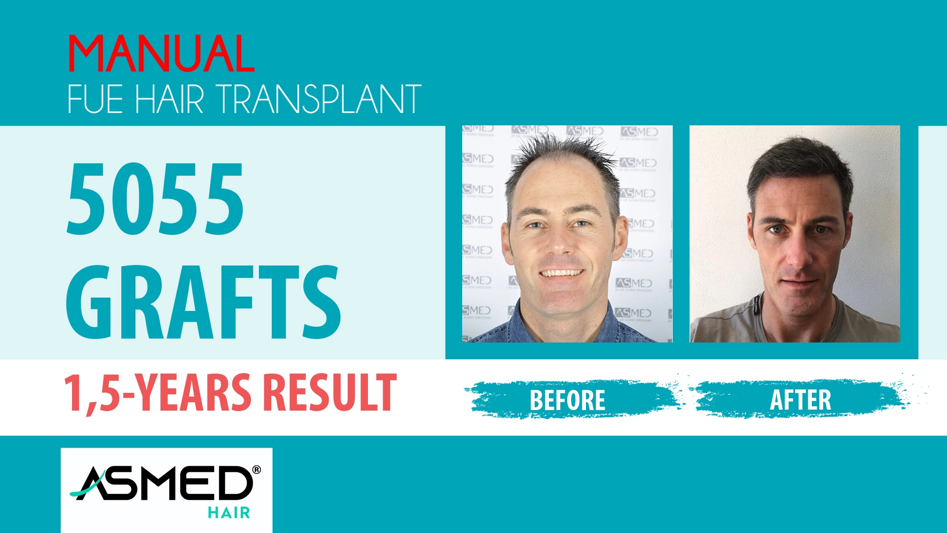 5055 grafts manual fue before after