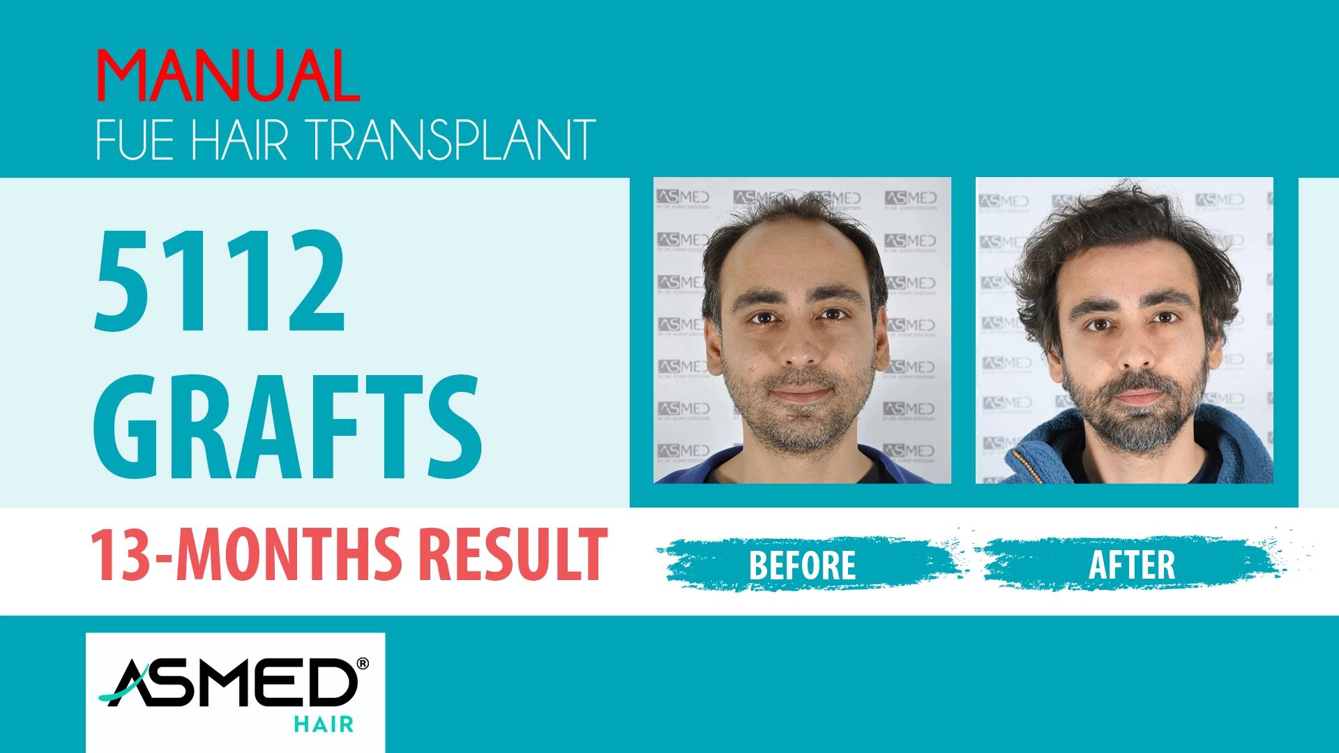 5112 grafts manual fue before after
