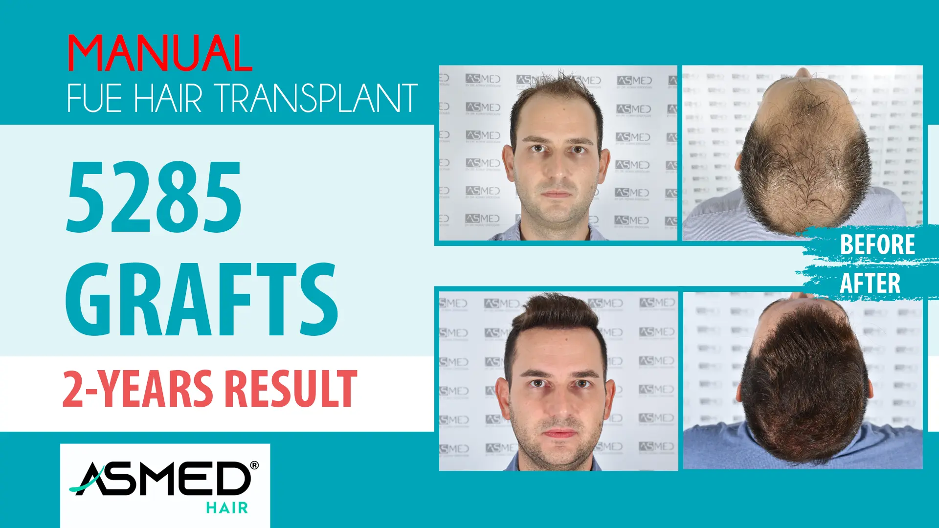 5285 grafts manual fue before after
