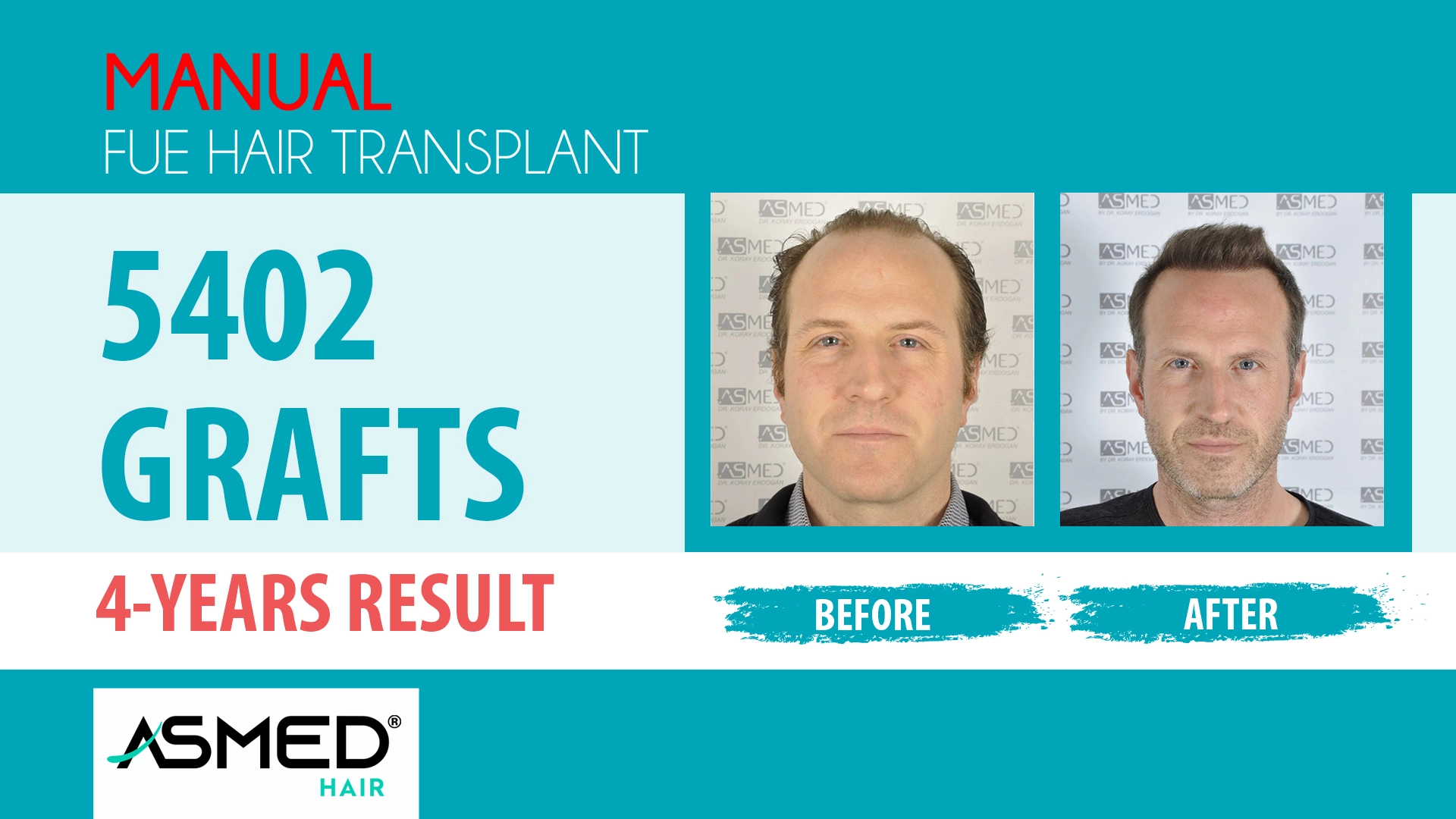 5402 grafts manual fue before after