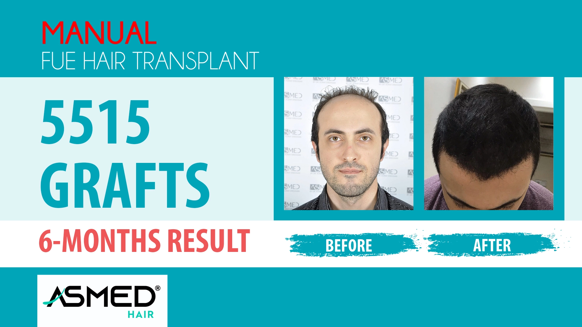 5515 grafts manual fue before after