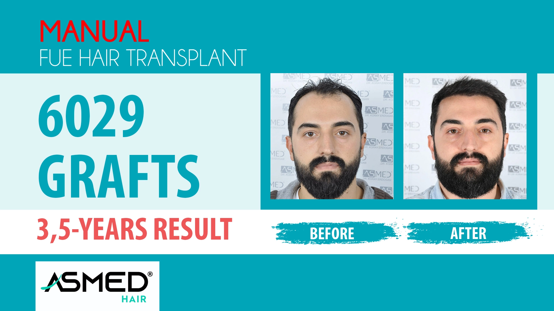 6029 grafts manual fue before after