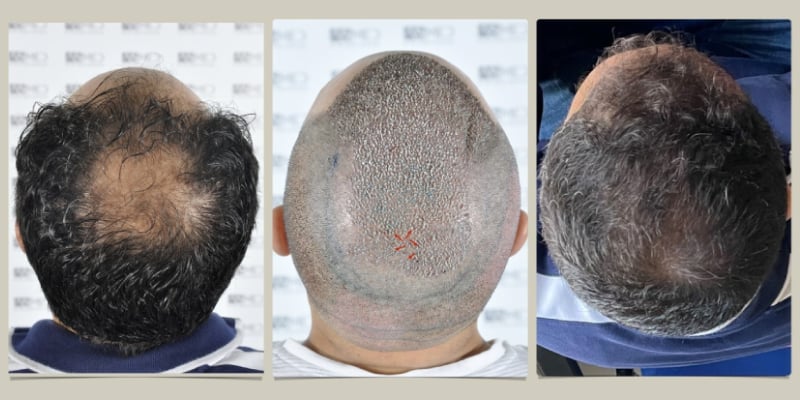https://www.hairtransplantfue.org/user/pages/12.blog/crown-hair-transplant/crown-hair-transplant.jpg