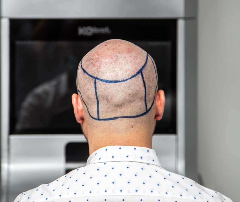 Hair Transplant Donor Area Recovery Asmed Hair Transplant